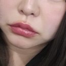 얀클리닉 내돈내산 실루엣플리프팅 후기 효과 붓기 💉✨ 전후 비교까지!