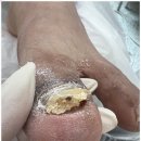 천안 신부동 발톱무좀 말끔하게 해결 오네또 문제성발전문점 각질 무좀 내성발톱