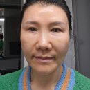 4 | 스킨부스터 가격 좋았던 리쥬란 4cc후기