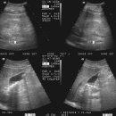 Multiple GB stone&Mild hydronephrosis etc. 이미지