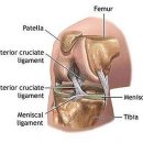 무릎 관절! 반월상 연골판 파열! 이미지