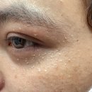 향남피부과의원 네이버블로그