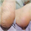 세종시 발관리 더채움 세종반곡점 여름맞이 발 각질관리하기