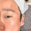 노블 | 파주운정역 피부과 여드름 흉터 치료 노블레이저 효과 내돈내산 후기