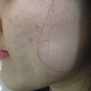 여드름흉터연고 부작용 힘들어서 받았던 차오름침 후기