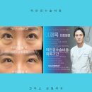하안검수술 회복기간 전후 비교 (강남 신사역 하안검전문의)