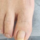 문제성 손발톱 해결사 [가령네일] 후기