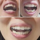 교정전문의 찾아 비발치돌출입교정 中(사진으로 확인하는 인비절라인 찐 후기)