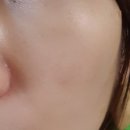 베이비멍 | 베이비콜라겐 주사 통증 후기