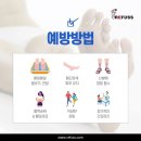 레푸스 경대점 이미지