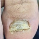 1순환로1107번길(999-0) | 청주 용암동 두꺼운발톱 변색발톱관리는 메디컬풋케어