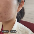 도도약국 | [여드름일지] 아젤리아 크림 2주일 사용후기 내돈내산 효과 사진첨부