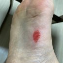 해온한의원 | [일주일 강제 휴식]부상_일주일뛰고 이주일 치료ㅠㅠ초보러너 부상_신도림한의원 추천_신도림 해온한의원