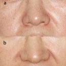 더퍼스트피부과의원 | 신촌피부과 추천? 피코토닝, 핵심은 후기가 아니라 ‘이것’입니다.