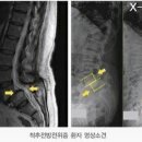 허리통증유발하는 허리 디스크 척추관 현착증 이미지