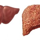 지방간의 진단과 관리 이미지