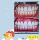 ::압구정로데오 치과:: 치아미백 충치치료 비용 내돈내산 후기