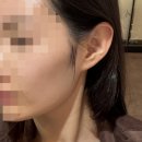 와이랩 | 와이랩 성형외과 스컬트라 1차+2차 시술 후기