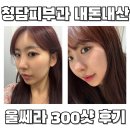 정피부과의원 | 청담피부과 내돈내산 울쎄라 300샷 통증 붓기 후기