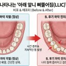 광성치과의원 | [인천논현동치과] "예전엔 가지런했는데..." 나이 들수록 삐뚤어지는 아래 앞니, 원인은?