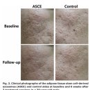 엑소좀(Exosome)은 정말 만능 피부 솔루션일까? 피부과전문의가 다루는 엑소좀의 효과와 한계, 그리고...