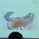 이다운치과기공소 | 네비게이션임플란트 디지털치과 눈으로 경험한 후기