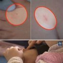 손과바늘 이미지