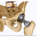 연산당당한방병원 | 부산고관절병원 수술 후에도 통증 계속된다면 확인해야 할 것