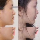 말턱고개 | 주걱턱 후기, 교정 비용 2번 쓰고 알게 된 점