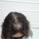 세여자 | 세 번째 여자 두피 문신 시술 후기 (용인)