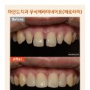 안산중앙치과의원 | 벌어진 앞니 때문에 웃기 불편하다면? 안산고잔동치과 무삭제라미네이트 사례