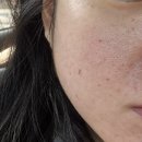 별별반점 | 이번엔 피부과 시술 후기 끓여옴! 리쥬란HB+, 디스커버리 피코 등 신부 관리