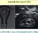 의천사) 산과 주요지식 : 임신주수 결정, 산전진찰, 기형아 검사, 양수검사 ,기형아 검사에서 고위험군인 경우 양수검사 필요한가, 성감별 이미지