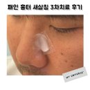 신림한의원 | 신림 근처 한의원 패인흉터 제거 새살침 치료 3차후기