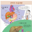 간이식 후, 치료초기에 흔히 나타나는 증상 - 체험담 이미지