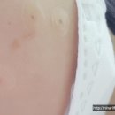 왕외과의원 | 점 잘빼는 곳 논산 왕외과에서 점빼고 왔어요 &gt;_&lt;