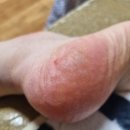 성애참의원 | 티눈 사마귀 치료 원내동 성애참의원