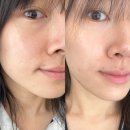 이수역 피부과 내돈내산 튠페이스 후기 + 얼굴살없는사람 리프팅 추천