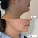 어울림빌 | [서산 루아뷰티] 서산피부관리 슬림젯 이중턱 체험 후기!