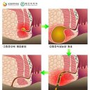 치루개 이미지