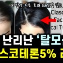 요즘 난리난 "탈모약의 게임체인저??" 클라스코테론 5% 리뷰 (용닥터) 이미지