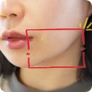 발산역 피부과에서 인모드FX리프팅 한번으로 턱살 없어진 후기