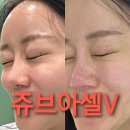 동탄피부과 쥬브아셀v 솔직후기! 5세대 스킨부스터 성분 효과 및 리쥬란 쥬베룩 비교 (통증, 다운타임)