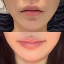 하이미의원 | 신사역입술필러 가로확장 비대칭교정 잘하는 하이미의원 내돈내산 후기