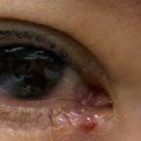 강남성모원안과의원 | [눈 비립종 제거후기 with강남성모원안과의원]