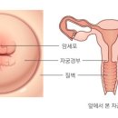 자궁암[uterine cancer] 이미지