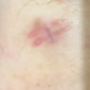 더와이즈치과병원 | 경기 광주_더와이즈 헬스케어의원 피지낭 수술 + 입원 추천 후기