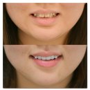 물방울치과의원 | 치아 라미네이트 가격 치과마다 다른 이유, 무삭제 기준까지