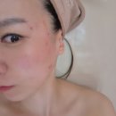 노진희피부연구소 | 울산 리프팅 후기 노진희피부연구소 온다리프팅 전후 공개