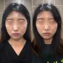 오오피부과의원 | 강남역피부과 예비신부관리 티타늄리프팅 효과, 통증, 다운타임 솔직후기